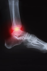 Medical x-ray knee joint image with arthritis ( Gout , Rheumatoid arthritis , Septic arthritis , Osteoarthritis knee )