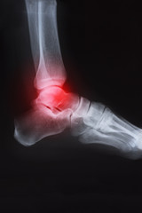 X ray image of ankle with arthritis