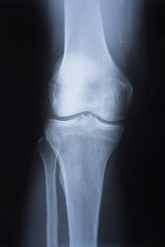 medical X ray image of knee