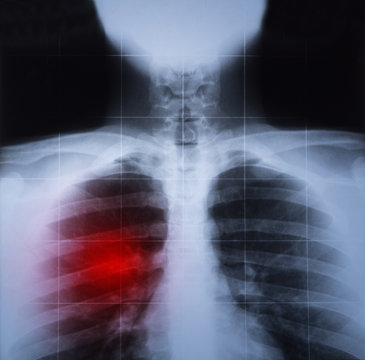 X ray image of chest and lung disease highlighted in red