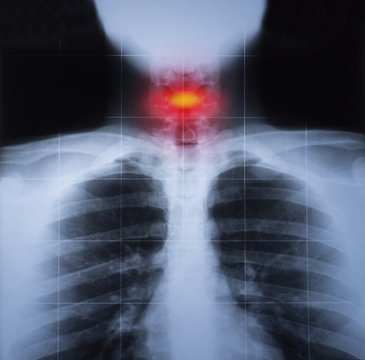 X ray image of chest and cervical trauma highlighted in red