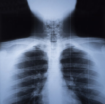 X ray image of human thorax
