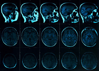 Magnetic resonance scan of the brain with skull. MRI head scan on dark background blue color. X-ray...
