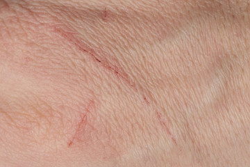 Cut from animal claws on human skin