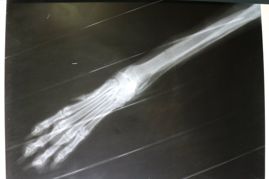X-ray picture of fissure on radius by dog