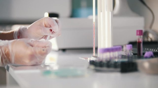 Medical clinic. A blood test. A nurse collecting a blood from the vitro in the pipette