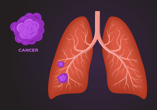 cancer cell on lung vector
