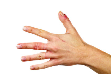 Female hand with panaritium on thumb finger. Isolated on white background