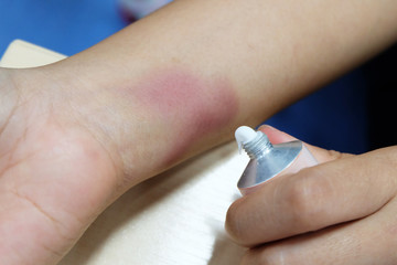 Woman apply this skin cream treatment bruise from playing badminton.