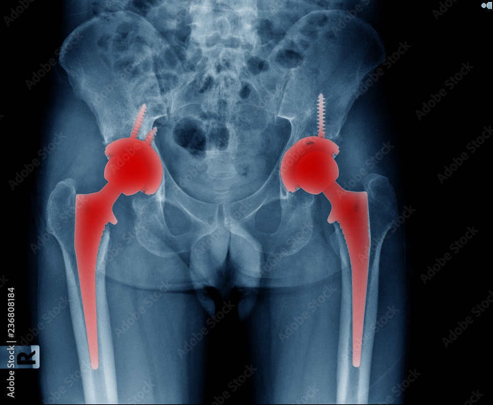 Sticker bilateral hip replacement of patient, hight qulity x-ray image of hip joint replacement both side