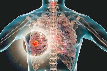 Lung cancer, 3D illustration showing malignant tumour in the ung