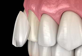 Dental Veneer: Central incisor Veneer installation Procedure. Medically accurate tooth 3D illustration