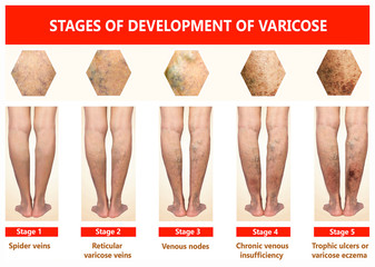 Varicose veins on a female senior legs. The stages of varicose veins. The old age and sick of a...