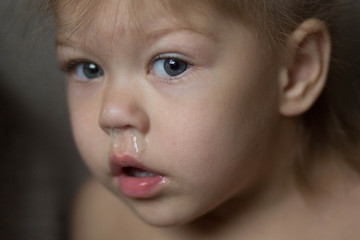 child with runny nose