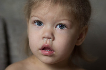 child with runny nose