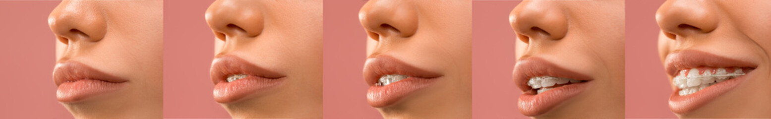 Fototapeta premium Beautiful young woman with teeth braces