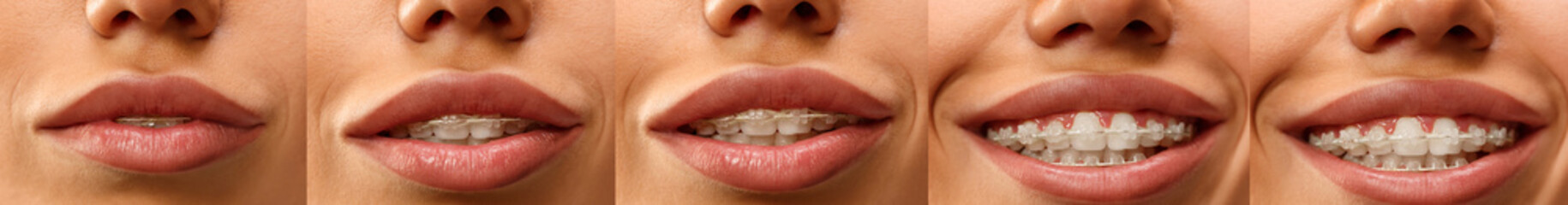 Beautiful young woman with teeth braces