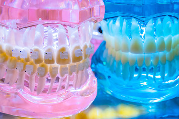 Human teeth. Jaw teeth. Alignment of teeth. Orthodontic plates. Braces Treatment of dental anomalies. Braces