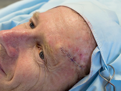 man BCC op close up middle aged