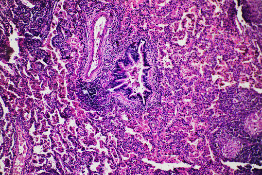 Tuberculoid Granuloma Of Hunman