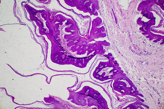 Skin papilloma of human micrograph.