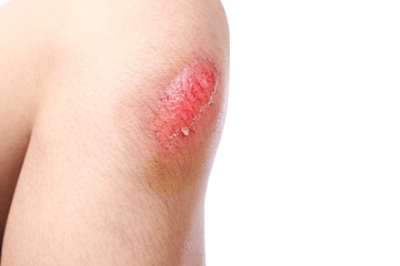 Asian boy got accident painful wound, scraped or injured on knee in football game. Close up of bleeding scraped after run accident isolated on white background.