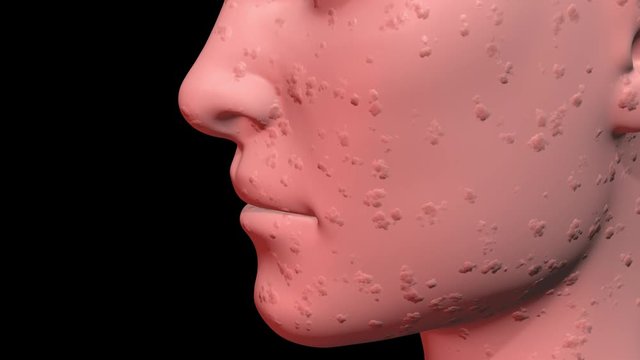Skin Problems : Acne, pimples , infection on face gradually vanish revealing new young smooth surface. 3d animation