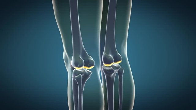 3D rendered shot of knee bone damaged from osteoarthritis was supplemented by treatment. Then slowly zoom out to see the full body of man anatomy.