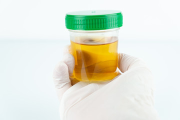 Urinalysis, cup with urine holding in hand