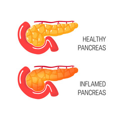 Inflames pancreas concept. Vector illustration - obrazy, fototapety, plakaty