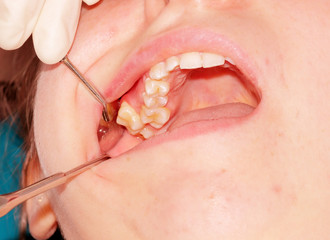 Dystopia of the right upper second molar (tooth 17)