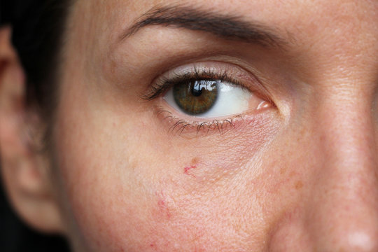 capillaries on the skin of the face,