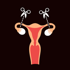 Tubal ligation and tubectomy - reproductive female and woman organ after sterilization and sterilisation. Permanent contraception and birth control. Vector illustration