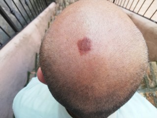 Naklejka premium Head of a man with seborrheic keratosis