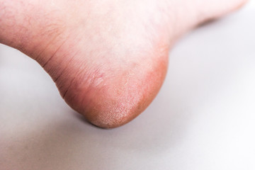 Dry woman heels with rough skin on gray background. Callus on foot.