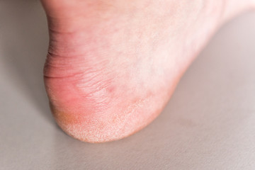 Dry woman heels with rough skin on gray background. Callus on foot.