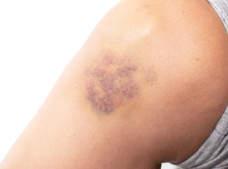 bruise on the skin of the leg - obrazy, fototapety, plakaty