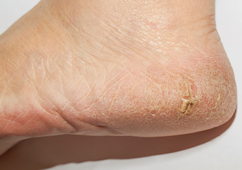 untidy women's heel with cracked skin with deep wounds and flaking close-up