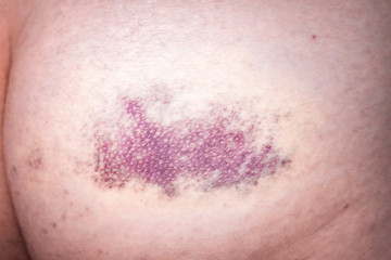 close up of bruise hit on the leg, hematoma