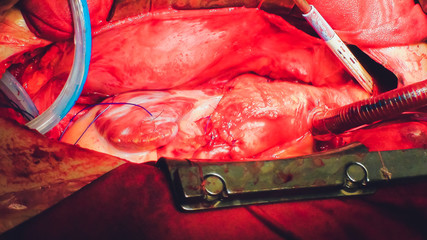 The process of cardiac surgery. The heart surgery.