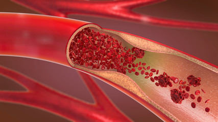 3d illustration of a constricted and narrowed artery and the blood cannot flow properly called arteriosclerosis - obrazy, fototapety, plakaty