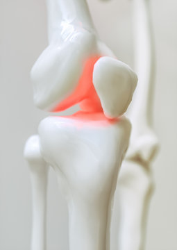 Osteoarthritis-covered knee - 3D Rendering