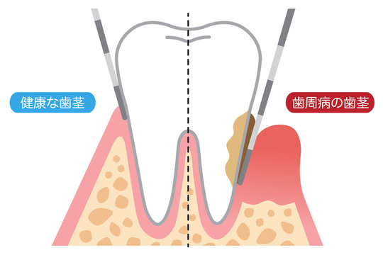 歯周病の歯茎と健康な歯茎
