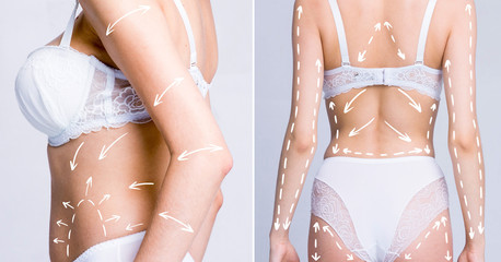 Cellulite fat removal scheme. White markings arrow on body woman. Set image, cosmetic surgery.