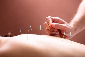 Therapist Performing Acupuncture Therapy On Woman's Back - obrazy, fototapety, plakaty
