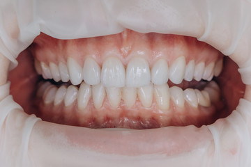 Fototapeta premium Finished ceramic front crowns. 8 units dental veneers.