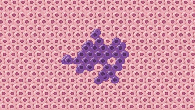 cancer cell stage and development graphic animation