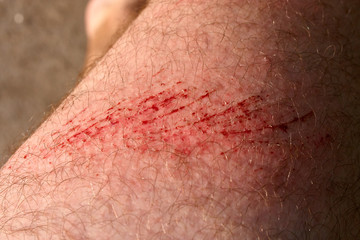 Scratch skin, wound or cut on the skin, red blood. Hairy part of a man body close-up