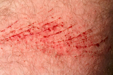 Scratch skin, wound or cut on the skin, red blood. Hairy part of a man body close-up