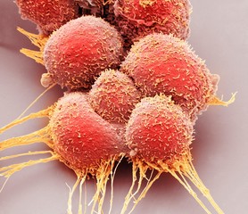 Close up of prostate cancer cells